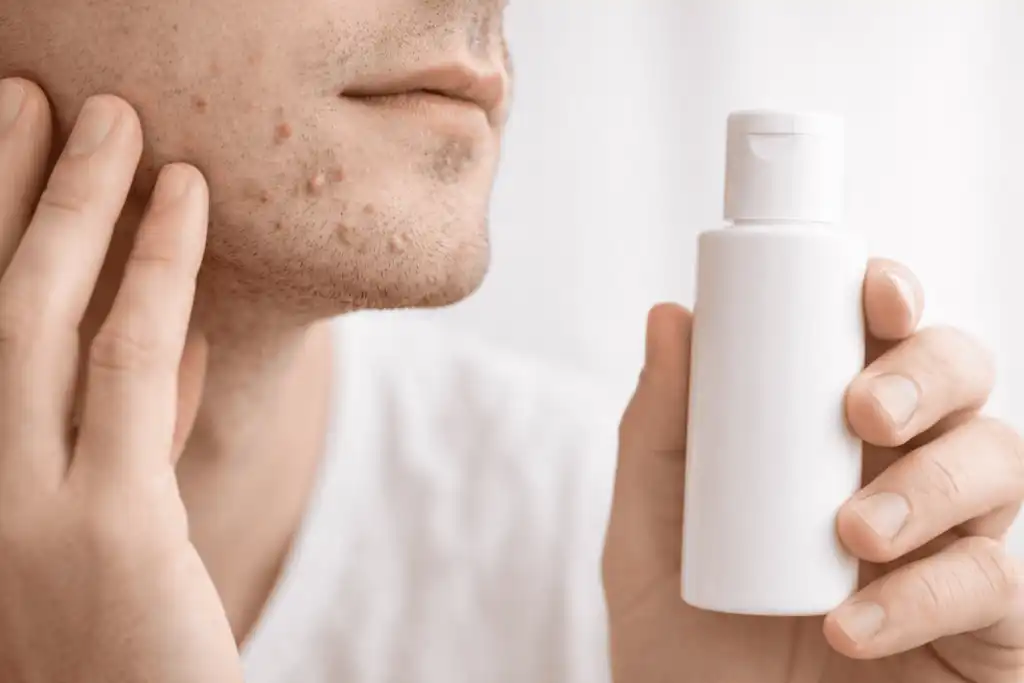 can stress cause acne