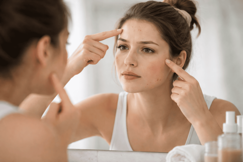 stress acne areas.