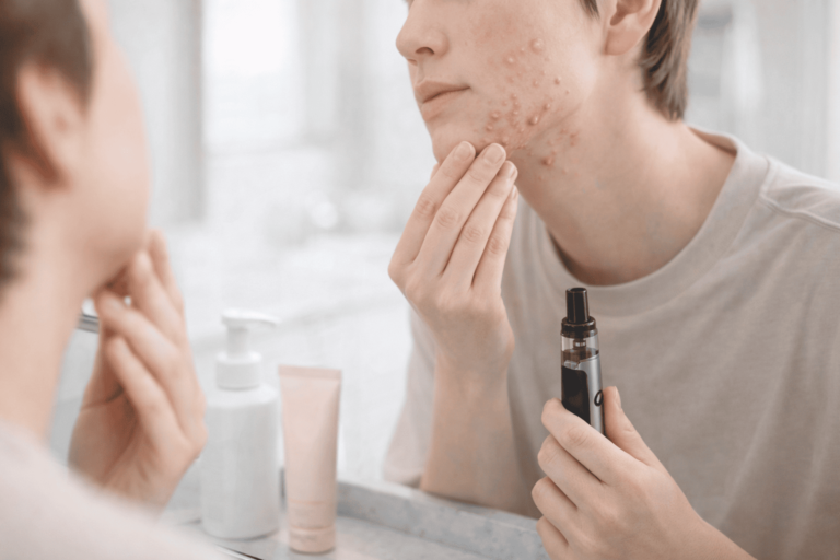 Can Vaping Cause Acne