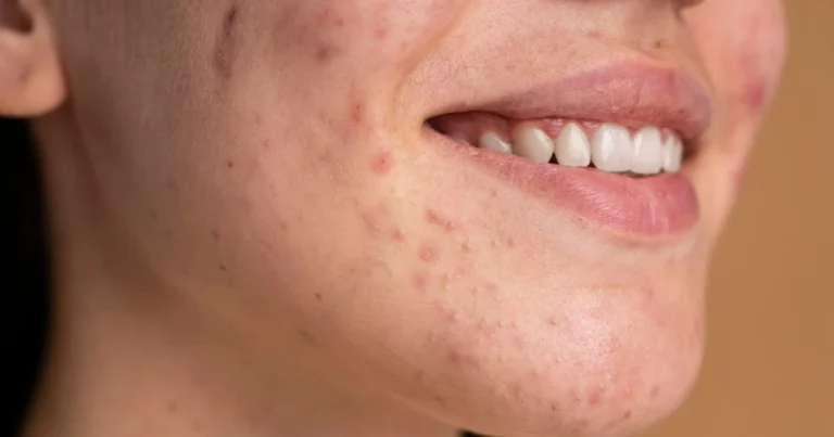 fungal acne treatment