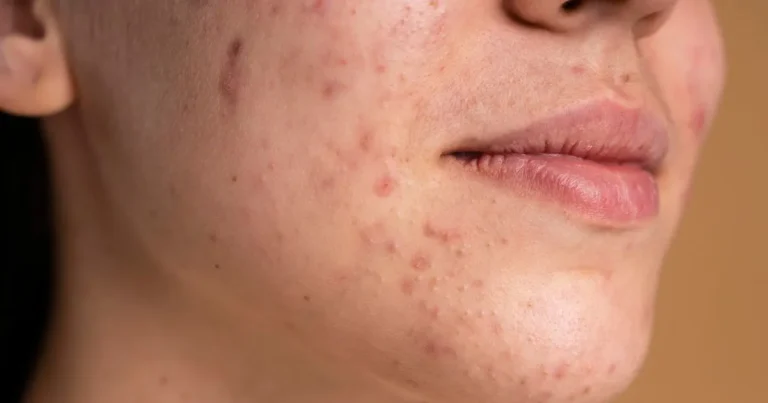 What is fungal acne