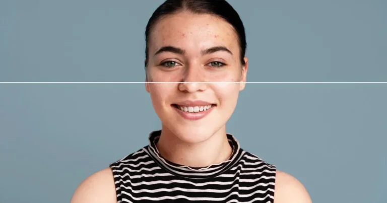 how to get rid of acne scars fast