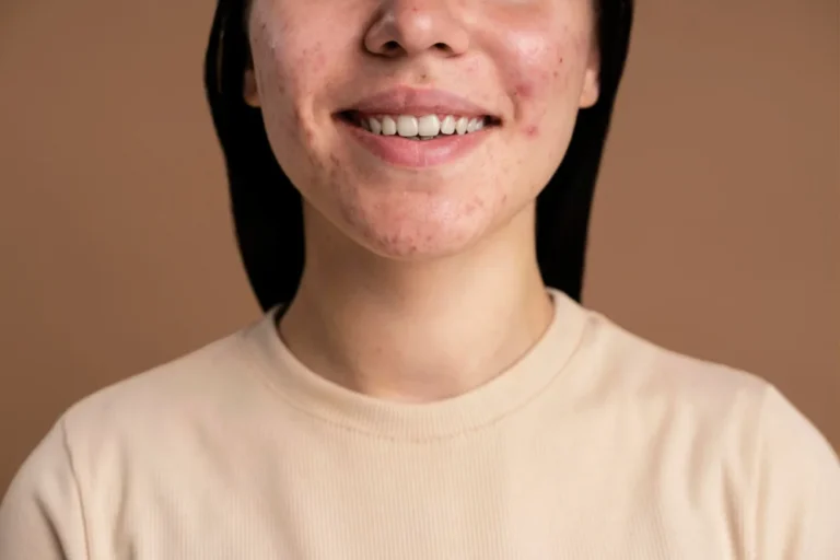 creatine zits