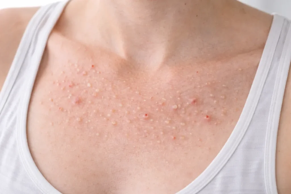 chest acne causes