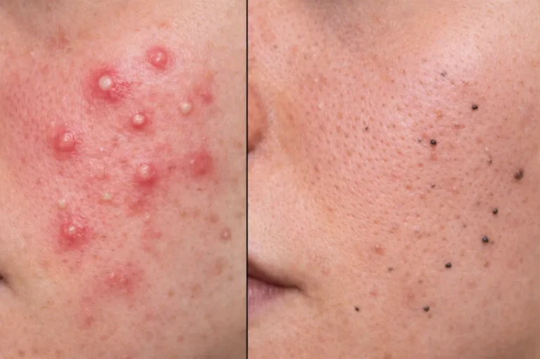 does salicylic acid cause purging