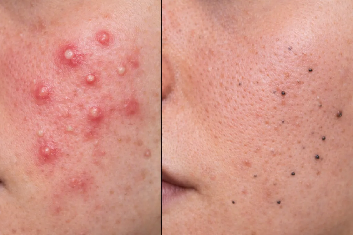 does salicylic acid cause purging