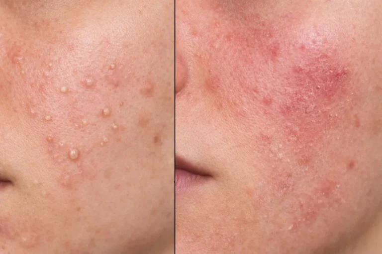 can you use benzoyl peroxide with salicylic acid
