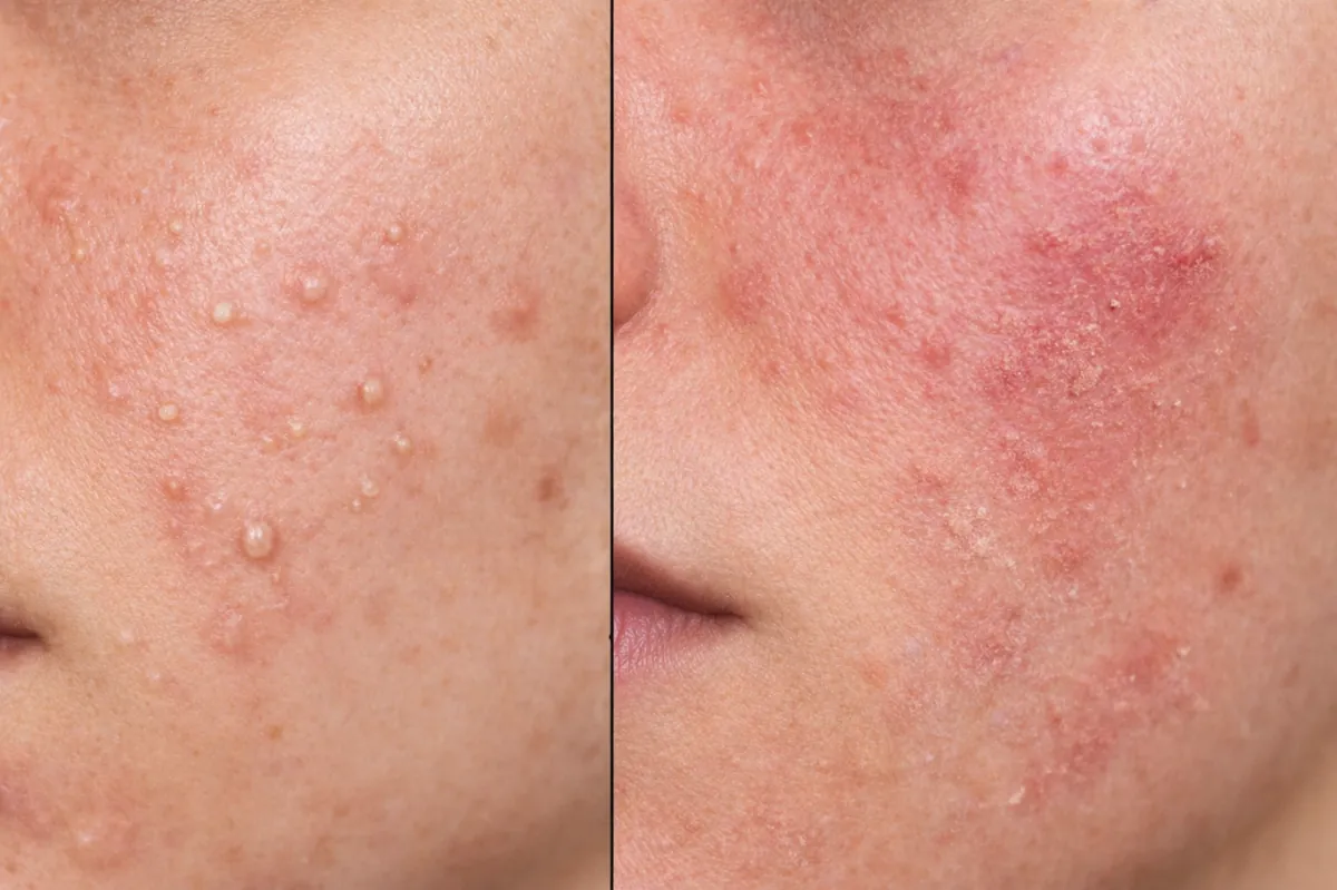 can you use benzoyl peroxide with salicylic acid