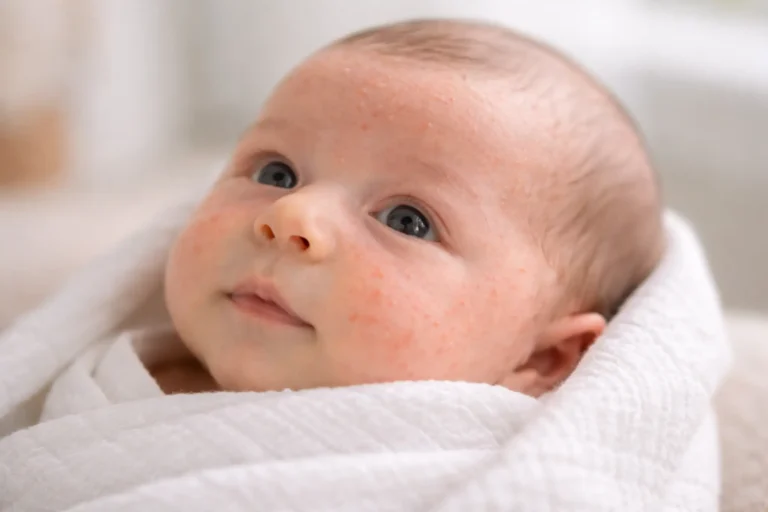 baby acne treatments