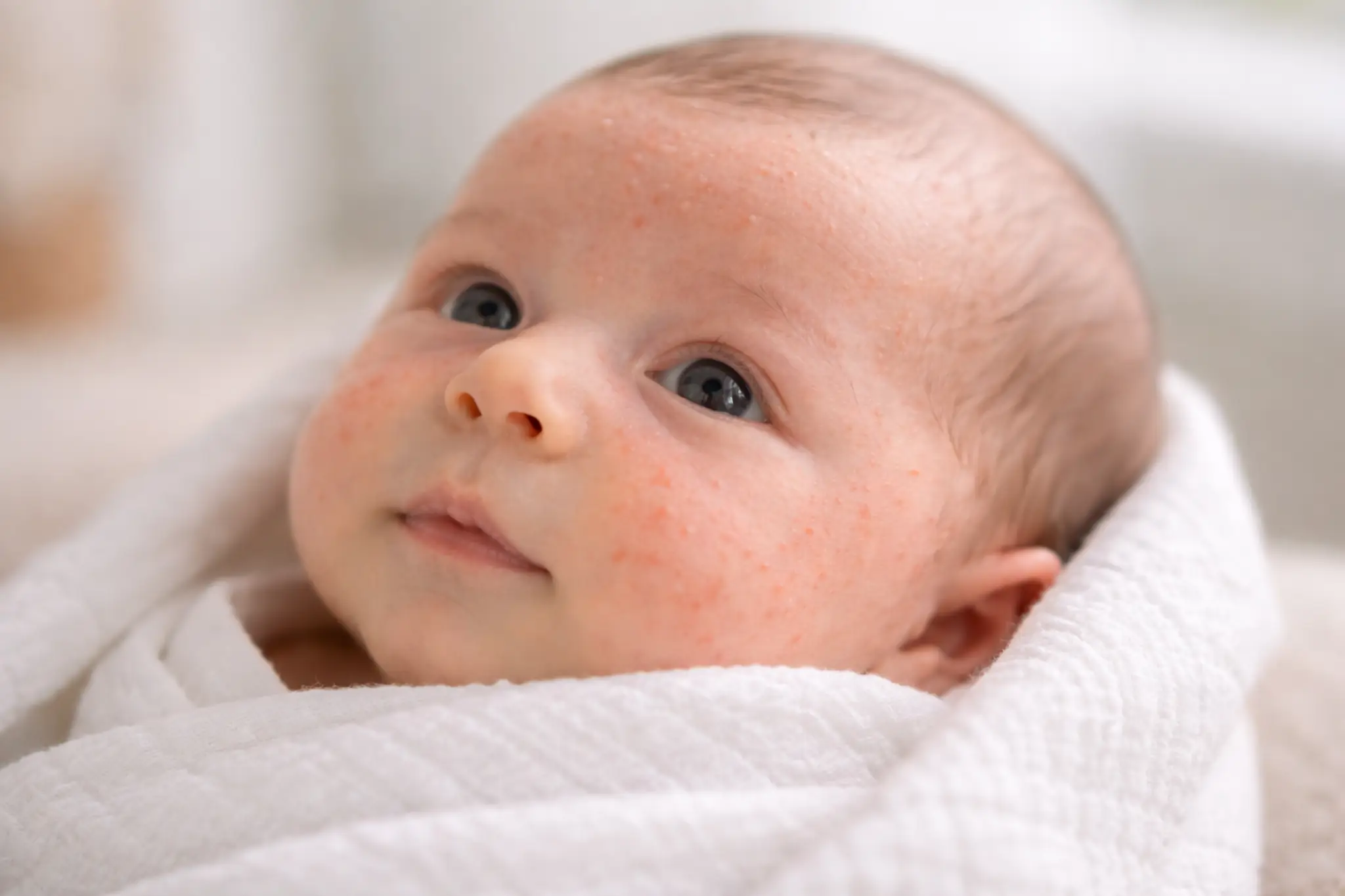 baby acne treatments