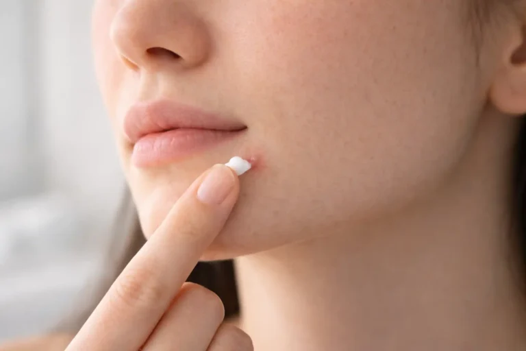 what has benzoyl peroxide