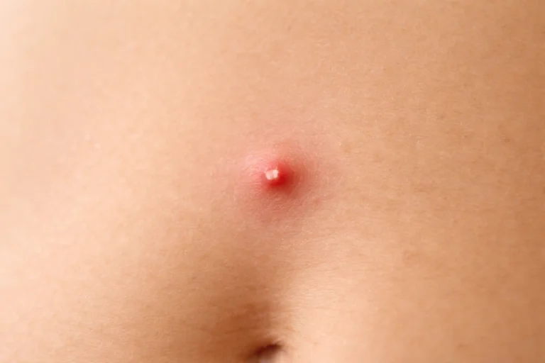 pimple on stomach