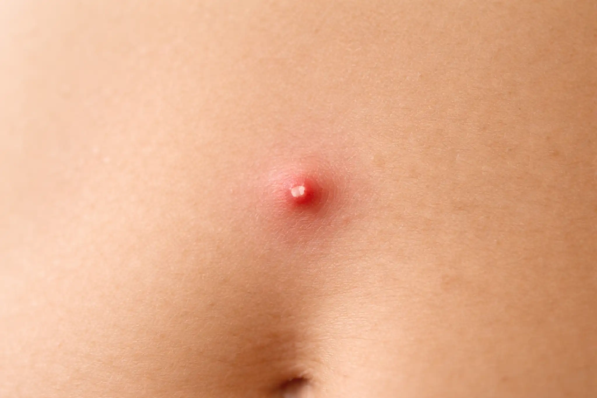 pimple on stomach
