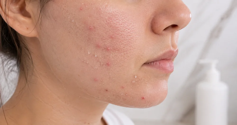 Dry Acne Prone Skin
