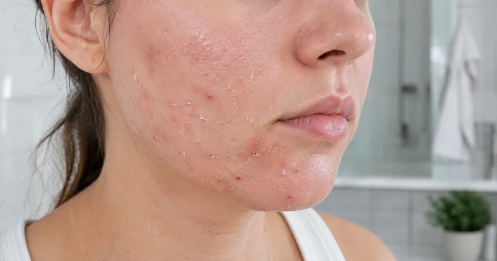 Dry Acne Prone Skin