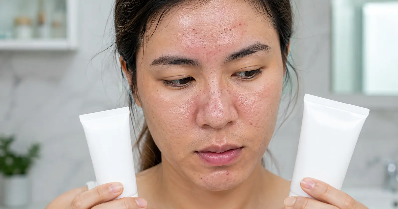 acne skin care products