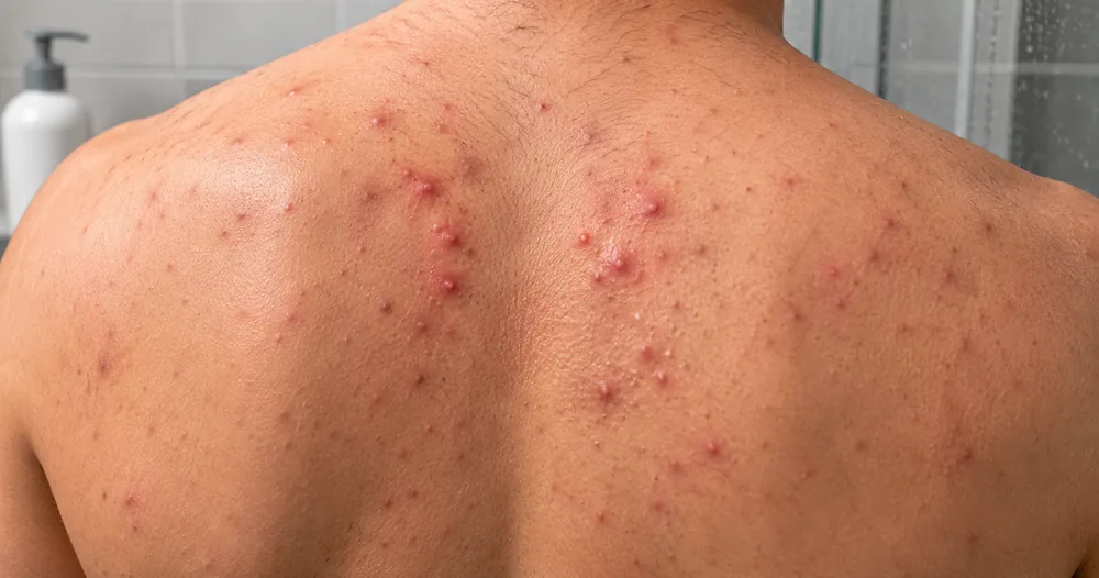 acne on back products