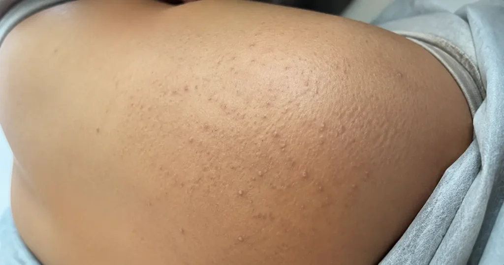 butt acne causes