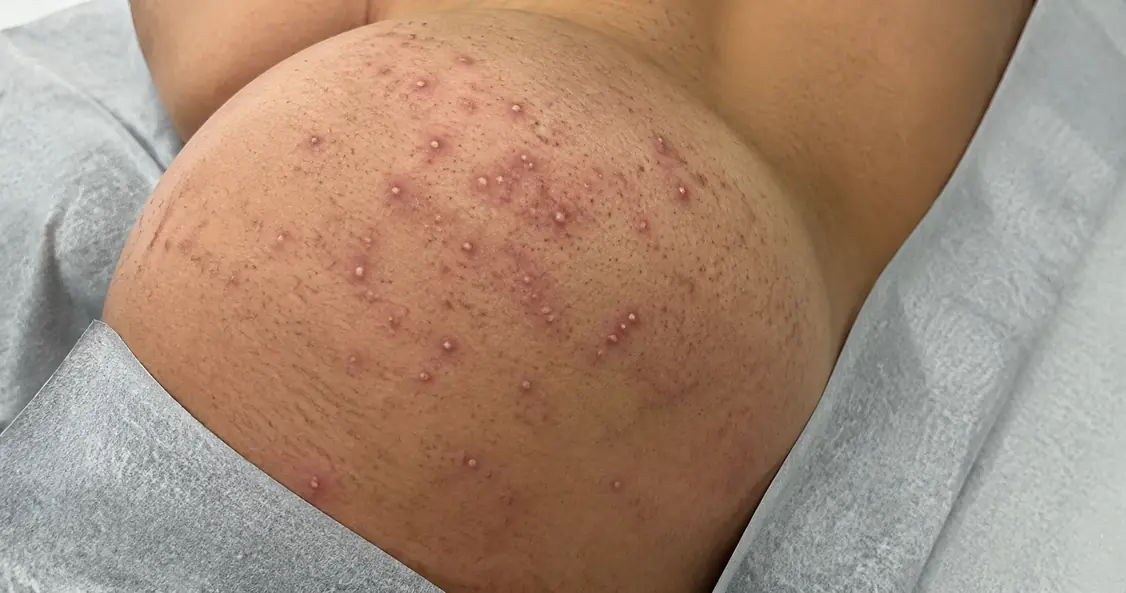 butt acne causes